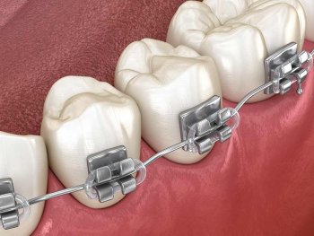 rendering of silver braces on teeth